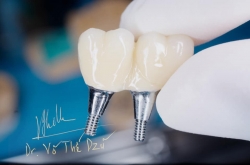 Phục hình bắt vít trên Implant 
