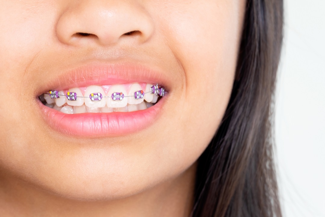 Nhổ răng khôn trong trường hợp niềng răng